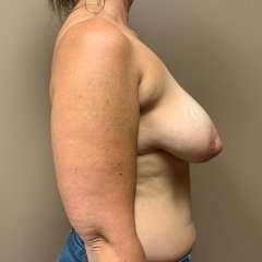 Breast Mastopexy Before & After Patient #321