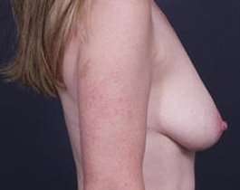Breast Mastopexy Before & After Patient #95