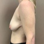 Breast Mastopexy Before & After Patient #340