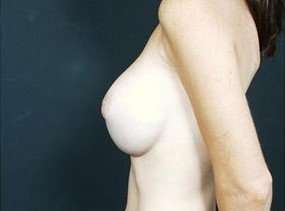 Breast Implant Revision Replacement Before & After Patient #384