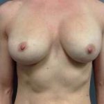 Breast Implant Revision Replacement Before & After Patient #394