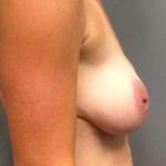 Breast Implant Revision Replacement Before & After Patient #422