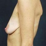 Breast Mastopexy Before & After Patient #110