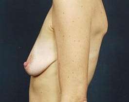 Breast Mastopexy Before & After Patient #110