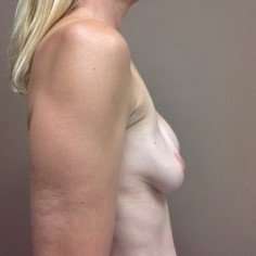 Breast Implant Revision Replacement Before & After Patient #550