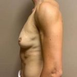 Breast Implant Revision Replacement Before & After Patient #558