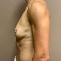 Breast Implant Revision Replacement Before & After Patient #558