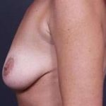 Breast Mastopexy Before & After Patient #123