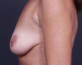 Breast Mastopexy Before & After Patient #123