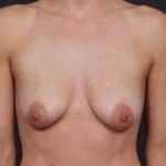 Breast Donut Mastopexy Before & After Patient #634