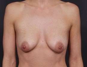 Breast Donut Mastopexy Before & After Patient #634