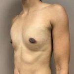 Breast Augmentation Before & After Patient #661