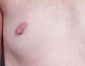 Breast Miscellaneous Before & After Patient #75
