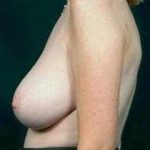 Breast Mastopexy Before & After Patient #148
