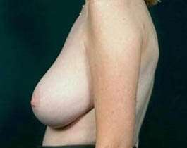 Breast Mastopexy Before & After Patient #148