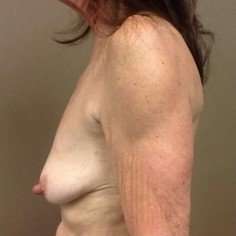 Breast Mastopexy Before & After Patient #221