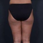 Liposuction Before & After Patient #1492