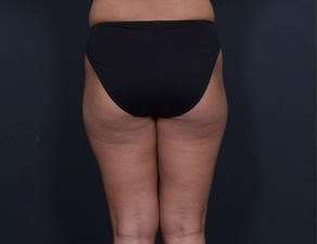 Liposuction Before & After Patient #1492