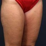 Liposuction Before & After Patient #1499