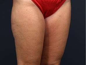 Liposuction Before & After Patient #1499