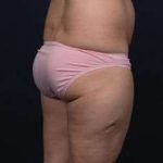 Liposuction Before & After Patient #1506