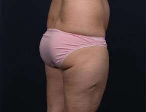 Liposuction Before & After Patient #1506
