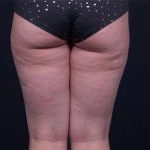 Liposuction Before & After Patient #1513