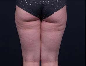 Liposuction Before & After Patient #1513