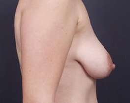 Breast Mastopexy Before & After Patient #155