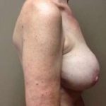 Breast Implant Revision Replacement Before & After Patient #404
