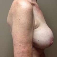Breast Implant Revision Replacement Before & After Patient #404