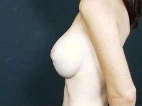Breast Implant Revision Replacement Before & After Patient #466