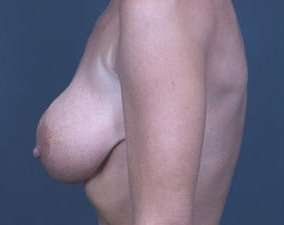 Breast Implant Revision Replacement Before & After Patient #482