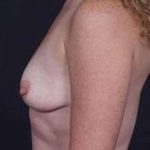 Breast Mastopexy Before & After Patient #162