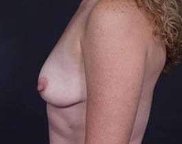 Breast Mastopexy Before & After Patient #162