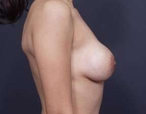 Breast Implant Revision Replacement Before & After Patient #489