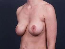 Breast Implant Revision Replacement Before & After Patient #508