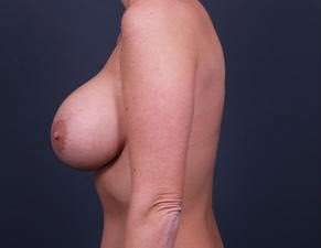 Breast Implant Revision Replacement Before & After Patient #597