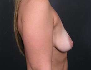 Breast Donut Mastopexy Before & After Patient #615