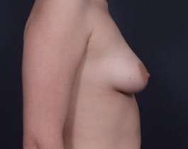 Breast Donut Mastopexy Before & After Patient #627