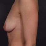 Breast Donut Mastopexy Before & After Patient #634