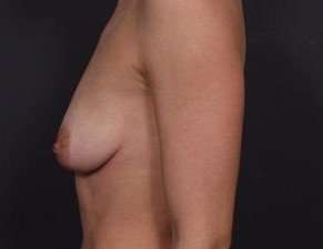 Breast Donut Mastopexy Before & After Patient #634