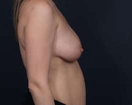 Breast Mastopexy Before & After Patient #169