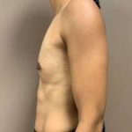Breast Augmentation Before & After Patient #661