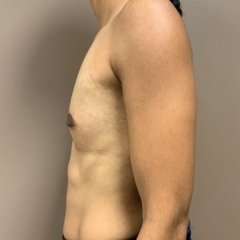Breast Augmentation Before & After Patient #661