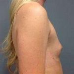 Breast Augmentation Before & After Patient #706