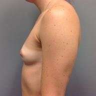 Breast Augmentation Before & After Patient #778