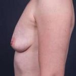 Breast Augmentation Before & After Patient #785