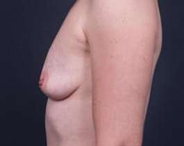 Breast Augmentation Before & After Patient #785