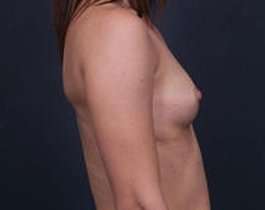 Breast Augmentation Before & After Patient #811